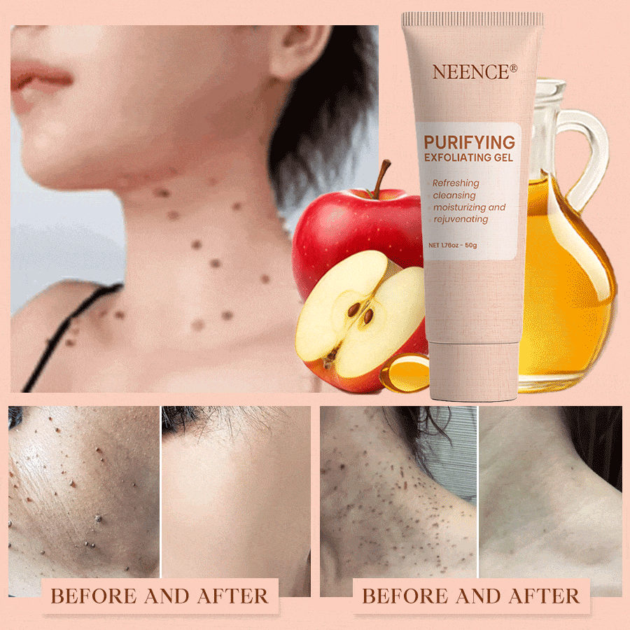 NEENCE® 🔥Purifying Exfoliating Gel for Acanthosis Nigricans, Exfoliation, Dark Spots, Skin Tags, and Eczema_Ultra01