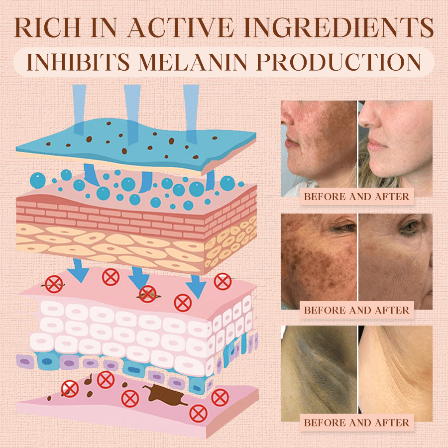 NEENCE® 🔥Purifying Exfoliating Gel for Acanthosis Nigricans, Exfoliation, Dark Spots, Skin Tags, and Eczema_Ultra01