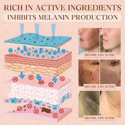 NEENCE® 🔥Purifying Exfoliating Gel for Acanthosis Nigricans, Exfoliation, Dark Spots, Skin Tags, and Eczema_Ultra01