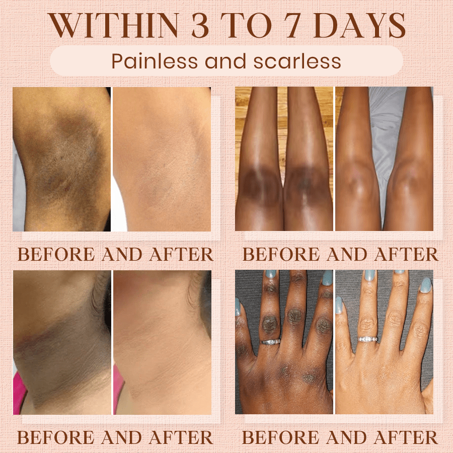 NEENCE® 🔥Purifying Exfoliating Gel for Acanthosis Nigricans, Exfoliation, Dark Spots, Skin Tags, and Eczema_Ultra01