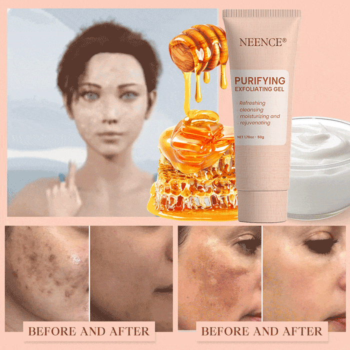 NEENCE® 🔥Purifying Exfoliating Gel for Acanthosis Nigricans, Exfoliation, Dark Spots, Skin Tags, and Eczema_Ultra01