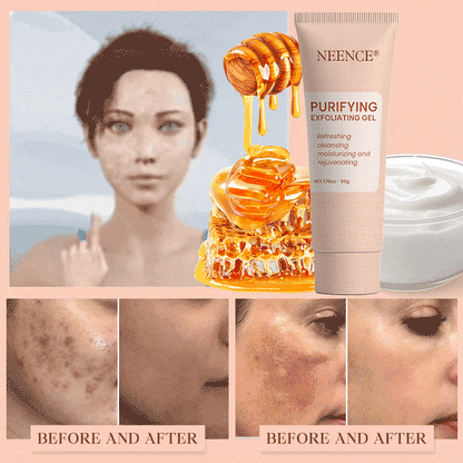 NEENCE® 🔥Purifying Exfoliating Gel for Acanthosis Nigricans, Exfoliation, Dark Spots, Skin Tags, and Eczema_Ultra01